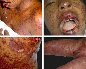Toxic Epidermal Necrolysis (TEN). A - Detachable skin portion above 30% of total body surface area. Severe involvement of mucous membranes, severe dysphagia causing sialorrhea, SCORTEN=3. B - Details of mucous involvement with severe ocular involvement. Ocular sequelae occurred, with formation of bilateral cicatrizing symblepharon and severe dry eye. C - Detail of a bulla. D - Child with TEN with thiabendazole as offending drug, with skin detachment of more than 60% percent of the total body surface area, with severe involvement of trunk, limbs and genitalia. SCORTEN=1