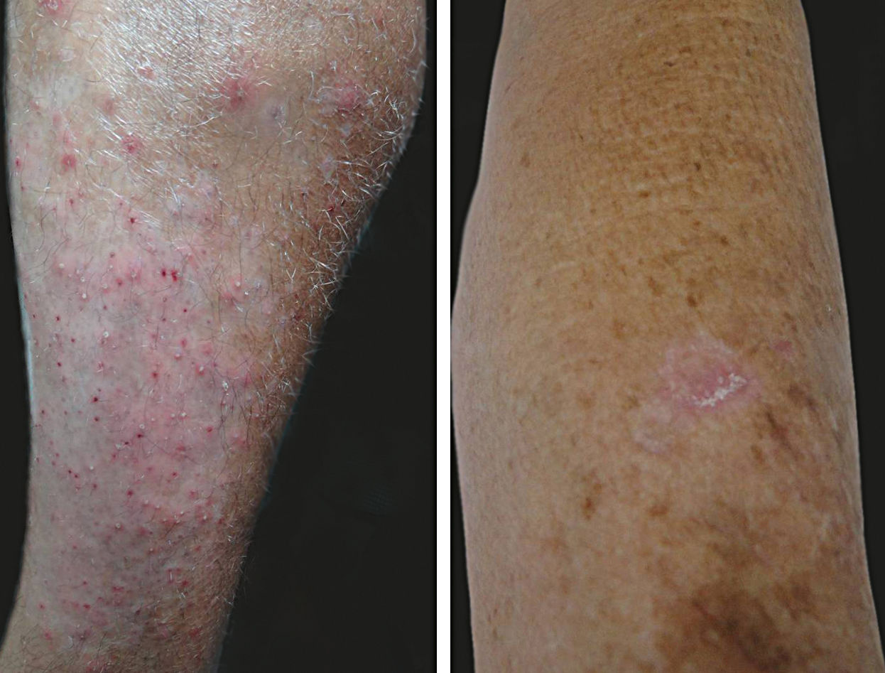 Fish Handlers Rash Profile of skin diseases in a community of fishermen in the northern ...