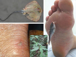 Left: marine stingray and injury in a colony’s fisherman. Right: injury caused by a catfish. Close up: erva-baleeira or black sage (Cordia verbenacea), used in alcohol solution for control of pain and inflammation caused by envenomations Photographs: Vidal Haddad Junior
