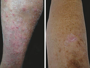 Left: typical fishermen folliculitis, who keep their legs constantly moist while loading and unloading the boats. Right: actinic keratoses in a fisherman, uncommon in the sample studied Photographs: Vidal Haddad Junior