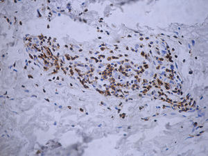 CD3 staining in the dermis (ABC-immunoperoxidase staining, x400)