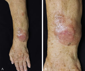 A - Erythematous tumor, slightly desquamative, painless, with a stony consistency on left forearm; B - Close-up of the lesion