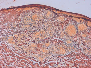 Reticulin stain showed multiple reticulin fibers surrounding granulomas (Reticulin stain, x100)