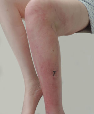 Ill-defined, painful, erythematous and edematous plaques on the left thigh and leg