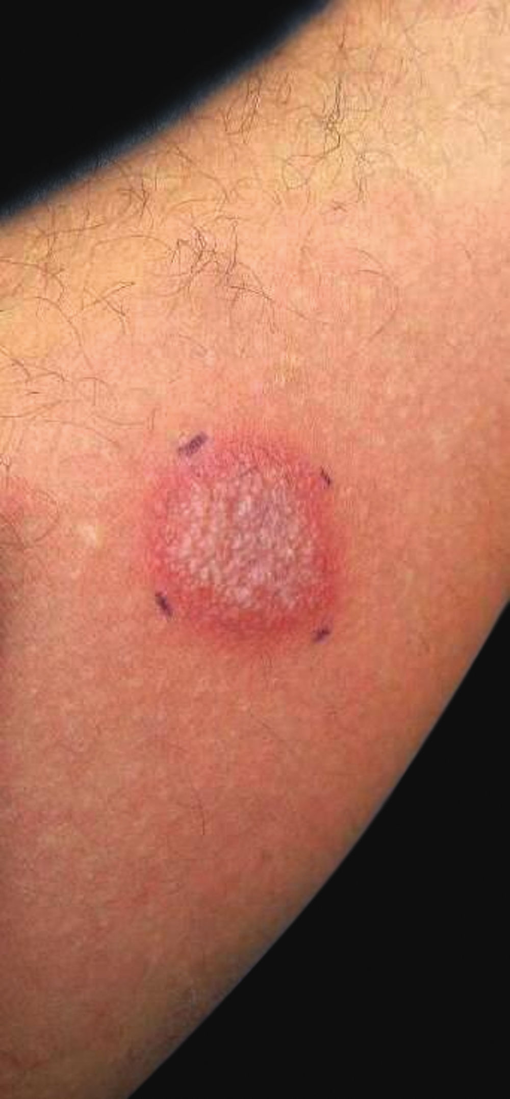 Scrolufoderma Scrofuloderma: a diagnostic challenge* | Anais Brasileiros de Dermatologia