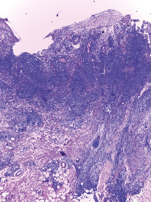 Ulcerated epidermis and remaining epithelium presenting pathological changes of viral cytopathic effect, represented by focal necrosis, keratinocytes with karyomegaly, multinucleation, ground-glass chromatin and molded nuclei. Dermis showed a dense/diffuse nodular lymphocytic infiltrate, with lymphocytes presenting pleomorphism, hyperchromatism, and grooved nuclei (Hematoxylin & eosin, x100)