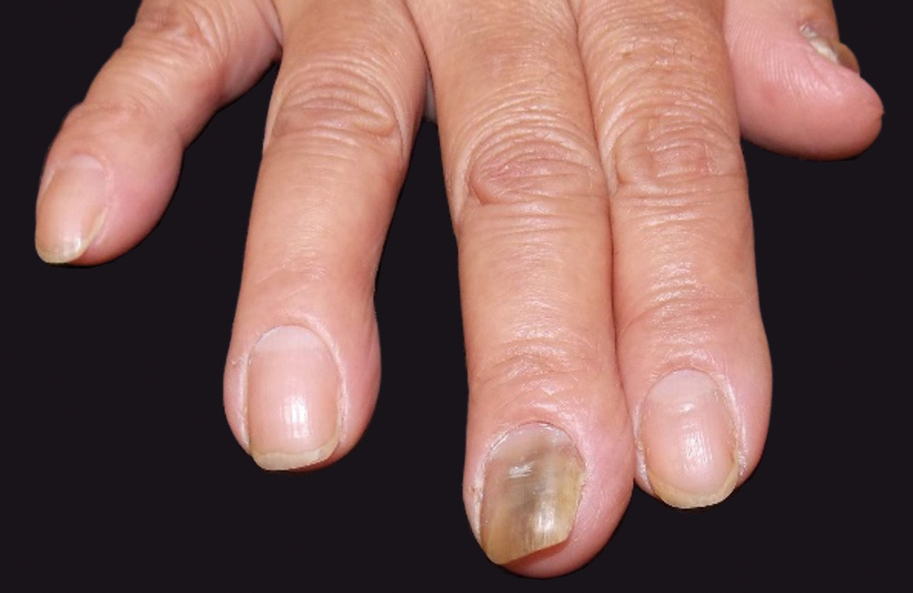 Alternatives to complete nail plate avulsion