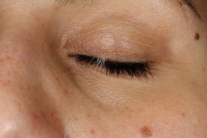 Clinical image of follicular vitiligo. Leukotrichia in a focal zone of the upper left eyelid. No skin vitiligo is present
