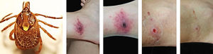 A - A female of Amblyomma ovale (Source: Álvaro A. Faccini-Martínez) B - Inoculation eschar in a patient with spotted fever caused by Rickettsia parkeri strain Atlantic rainforest. (B - 1) 12 days after the tick bite (DATB). (B - 2) 14 DATB. (B - 3) 23 DATB. (B - 4) 30 DATB (Source: Krawczak, et al., 20163)