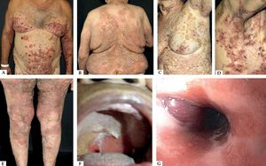 Classic bullous pemphigoid – Tense blisters with hemorrhagic (A) and hyaline (B) content on the trunk and limbs with erythematous and edematous background; hyaline blisters without inflammatory signs (C); excoriated papules and blisters with crusts in the axillary region (D); brownish and erythematous plaques with overlying purulent and hyaline blisters (E). Mucosal involvement - blisters and erosions on the palate (F); blister in the esophagus (G)