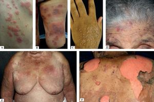 Nonbullous pemphigoid – Urticariform: confluent erythematous and edematous papules on the trunk (A). Erythema multiforme-like: targetoid plaques on the thighs (B). Prurigo-like: lichenified papules on the dorsum of the hand (C). Excoriations on the frontal region (D). Eczematous: erythematous-brownish confluent plaques on the trunk and upper limbs (E). Toxic epidermal necrolysis-like: erosions on the dorsum (F)