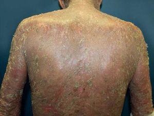 Bullous pemphigoid presenting as exfoliative erythroderma without blisters