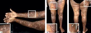 Bullous pemphigoid triggered by UVB-NB phototherapy in a patient with psoriasis - Erythematous and brownish patches with blisters on the upper (A) and lower (B) limbs; psoriatic plaque on the thigh (C)