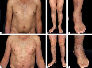 Lichen planus – Violaceous flat papules with mild desquamation on the upper (A) and lower (B) limbs, and feet (C). Lichen planus pemphigoid – Confluent macules and papules on the trunk (D) and lower limbs (E) with tense hyaline blisters on the feet (F)
