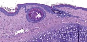 Wound microscopy from a control ear. Inclusion cyst. (Hematoxylin & eosin, x50)
