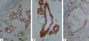 Immunohistochemistry with anti-collagen IV antibody. A - Demarcation of the wall of ectatic dermal vessels (x150). B - Detail of the clear demarcation of tortuous vessels (x400). C - Normal control with a normal vessel wall (x400)