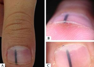 A - Physical examination of 2-mm-wide black longitudinal streak starting at the distal surface of the right thumb. B - Distal dermoscopy highlights a localized thickening of the nail plate with subungual hyperkeratosis at the hyponychium. C - Dorsal plate dermoscopy shows a sharply delimitated longitudinal melanonychia on the dorsal surface of the nail plate
