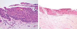 Histopathological analysis revealed: A - Hematoxylin & eosin (x200) moderate acanthosis of the nail matrix, with proliferation of matrical onychocytes with small monomorphic nuclei with condensed chromatin and scant cytoplasm. Arrow: area of keratinization simulating a squamous eddy. B - Fontana Masson (x100): melanin within the cytoplasm of matrical onychocytes and sparse melanocytes in the dendrites
