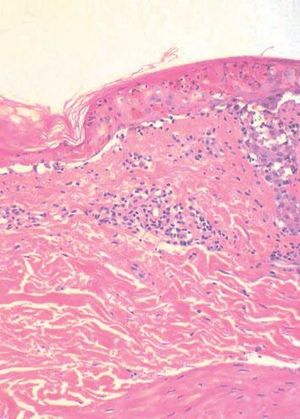 Apoptotic keratinocytes in the epidermis with subepidermal detachment. Sparse inflammatory infiltrate composed of lymphocytes in the papillary dermis and occasional exocytosis. (Hematoxylin & eosin, x30)