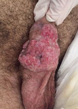 Ulcerative and vegetative skin lesion on the body of the penis