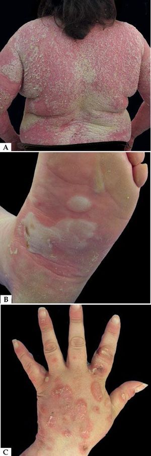 A - Extensive desquamative erythematous plaques; B - Tense and confluent blisters on the sole; C - Tense and confluent blisters on the back of hand