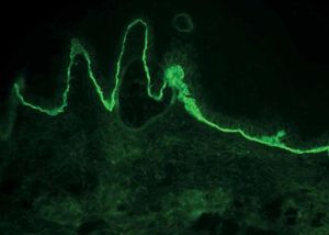 Direct immunofluorescence: C3 deposits with a linear pattern in the dermoepidermal junction