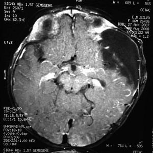 Tomographic image of arachnoid cyst in the left middle cranial fossa