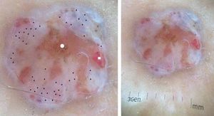 Dermoscopy: presence of whitish-pink areas, surrounded by pinkish-white halos (*), distributed diffusely in “frog-eggs” pattern, associated with a central exulceration (circle) and with a polymorphous vascular pattern (square)