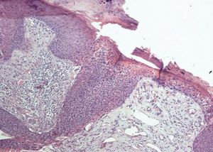 Exulcerated area with hematic crust, as seen in the dermoscopy (Hematoxylin & eosin, x100)