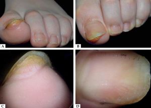 A–B: Clinical appearance of subungual exostosis with elevation of the nail plate. C: Dermoscopy of the free edge showing hyperkeratosis and vascular ectasia. D: Dermoscopy of nail plate showing onycholysis