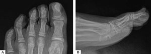 A–B: X-ray revealing bony proliferation originating from the distal phalanx of the first toe in two different projections