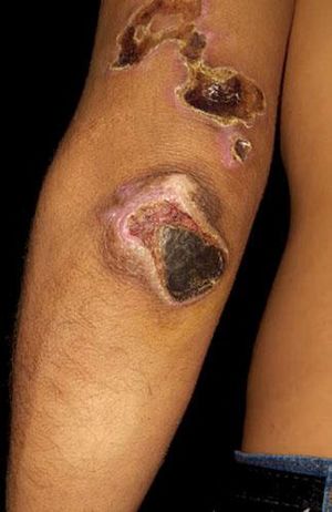 Extensive crusted ulcers in the left arm and elbow, after local hot water compress and mild hypo-chromic macule with scarce hairs in the forearm