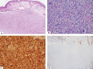 A - Dermal tumoral infiltration (Hematoxylin & eosin x20) B - Pleomorphic tumor cells with multinucleated giant cells (Hematoxylin & eosin x200) C - Positive staining for CD10 (x200) D - Negative staining for p63 (x20)