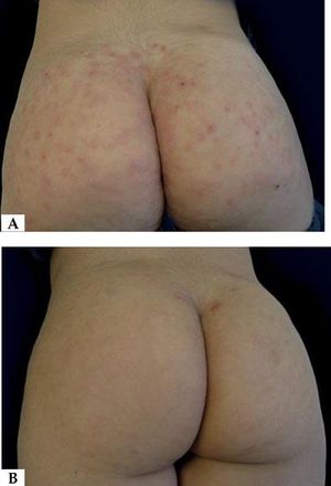 a-Excoriated papules and nodules b - Complete resolution of lesions three months after treatment