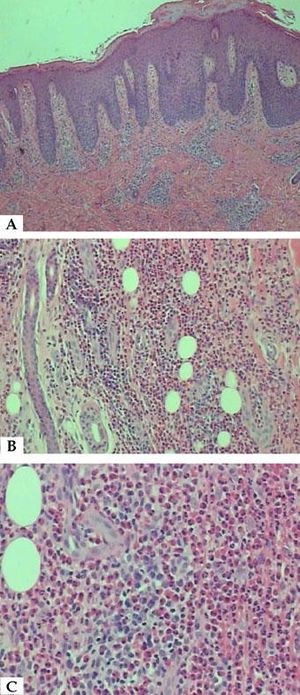 A - Skin showing acanthosis, parakeratosis and inflammatory infiltrate in superficial and deep dermis (Hematoxylin & eosin, x40), B - Hypodermis with dense inflammatory infiltrate, predominantly eosinophilic (Hematoxylin & eosin, x100) and C - Eosinophils in septa of subcutaneous adipose tissue (Hematoxylin & eosin, x200)