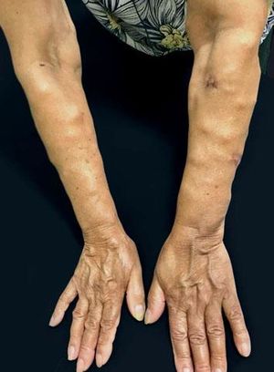 Nodules covered by normal-looking skin all over the upper limbs