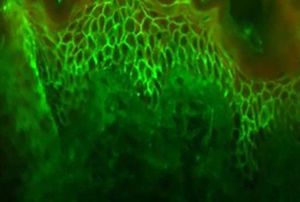Indirect immunofluorescence with intercellular intraepi-thelial IgG