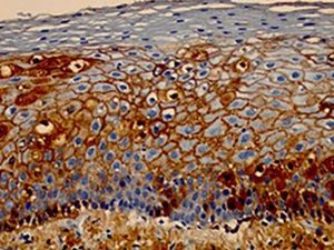 Immunohistochemical examination using an IgG marker (C3 is similar) showing intense intercellular immunoexpression