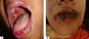 A. Vesicles, blisters, and exulcerations on the lips. Exulcerations in the buccal and palate mucosa; B. Serohematic exulcerations and crusts on the lips