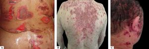 A. Vesicles, blisters, and exulcerations on the dorsum; B. Exulcerations and crusts on the back; C. Exulcerations and crusts on the scalp
