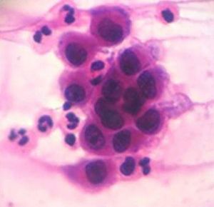 Grouping of acantholytic keratinocytes observed on cytological examination by the Tzanck method (Hematoxylin & eosin, x400)