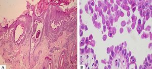 A - Histopathological examination, showing a blister with suprabasal cleavage level affecting the epidermis and follicular epithelium (Hematoxylin & eosin, x40); B - In detail, acantholytic keratinocytes in the blister content (Hematoxylin & eosin, x400)