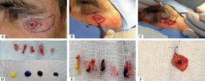 A - Marking margins; B - Excision of lesion with double-bladed scalpel; C - Removal of safety margin with double-bladed scalpel; D - Separation of margins for subsequent analysis and staining; E - Specimens marked with India ink; F - Marking with nylon suture at 12:00. Protocol for surgical procedure performed in patients with squamous cell skin cancer Source: Girschik et al, 2008.17