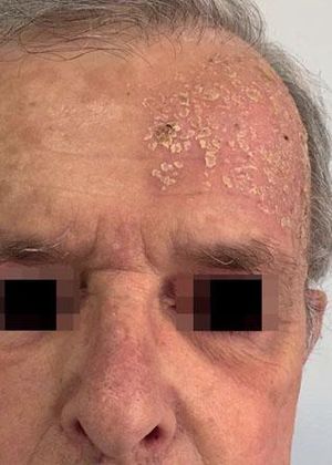 Patient follow-up (severe local skin reaction). Day 4