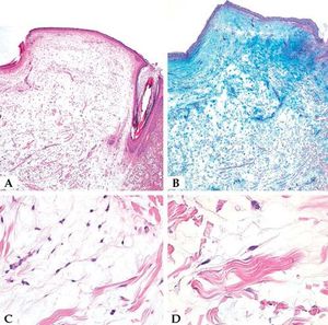 A. Microscopic examination showed myxomatous stroma in the dermis, atrophy of the epidermis, scattered spindle-shaped fibroblasts, and dissociation of collagen fibers in the dermis (cleft-like spaces) (patient #1) (Hematoxylin & eosin, x20); B. Alcian blue staining showed abundant mucin deposits (patient #1)(x20); C and D. Higher magnifications show spindle and stellate fibroblasts in a myxoid area (patient #1) (Hematoxylin & eosin, 5C x200; 5D x 400)