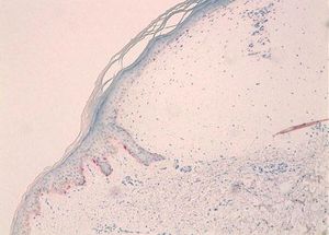 Melan-A staining shows reduced melanocytes in the epidermis above the mucin deposition in the dermis (patient #2) (x40)