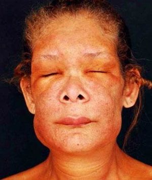 Yellowish periorbital and mandibular plaques resulting in blepharoptosis; upper lip infiltration