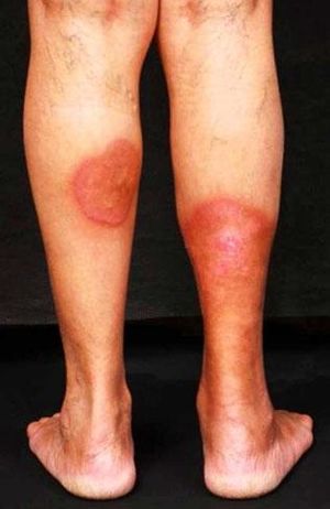 Circular yellowish-red plaques on the legs