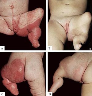 Lower limb and genital lesions before and during treatment - four-month follow-up