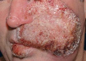Leishmaniasis: ulcerated and verrucous lesion on the left malar-zygomatic region. Ulcerated and infiltrated lesion on the lower-lip